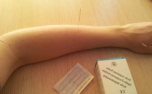 針灸美容的特點總結